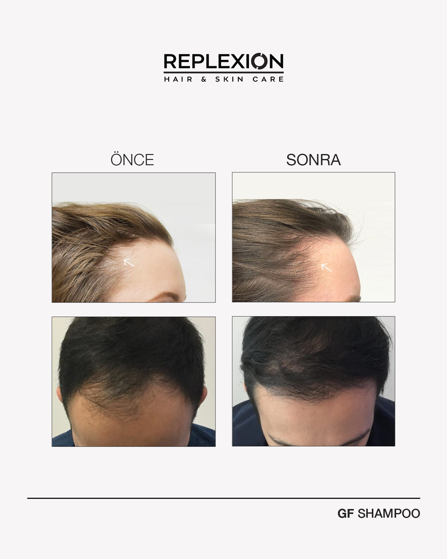 Replexion GF Hair Serum (120ml) – Advanced Anti-Hair Loss & Rapid Growth Stimulator